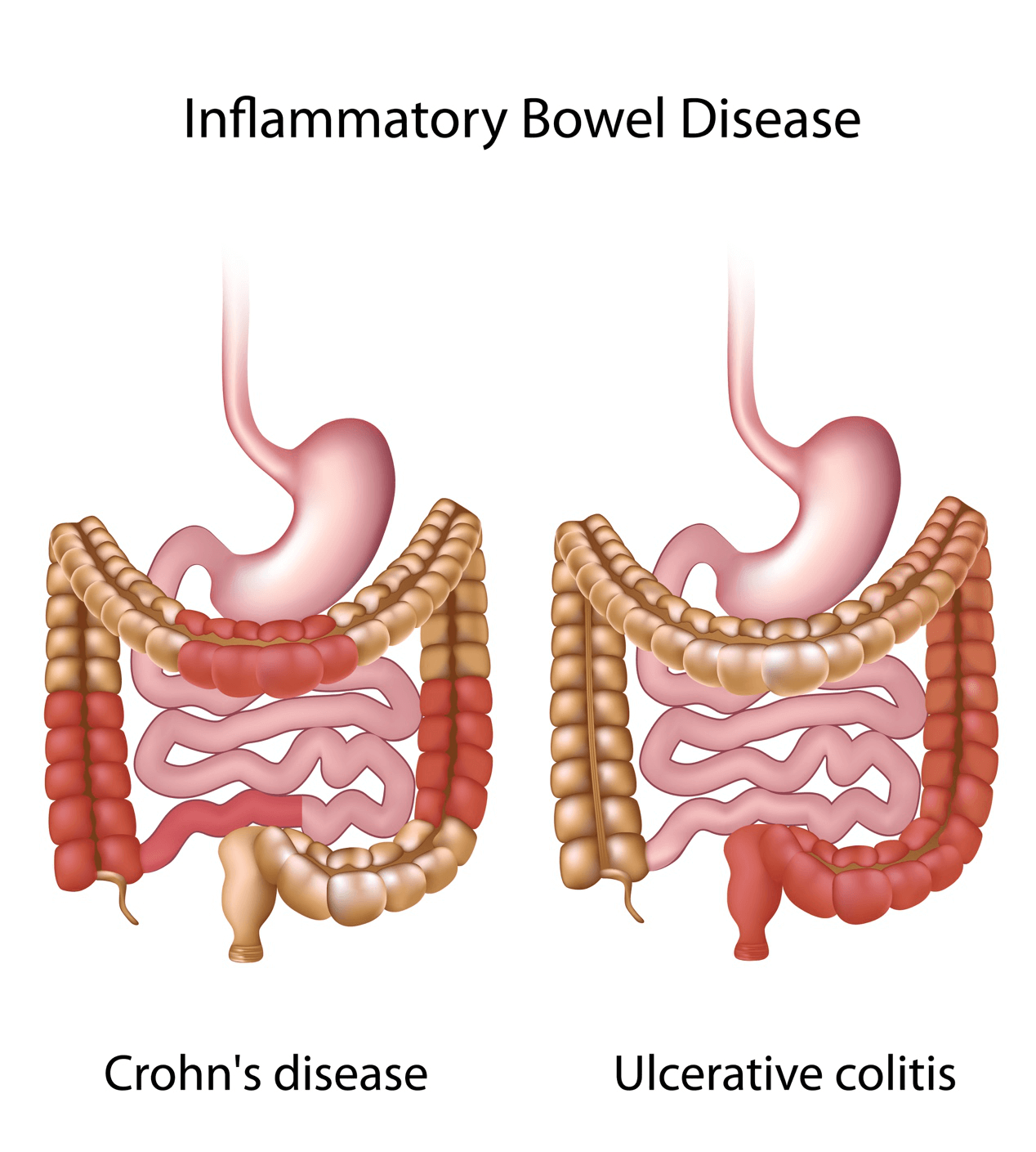 Crohn’s disease