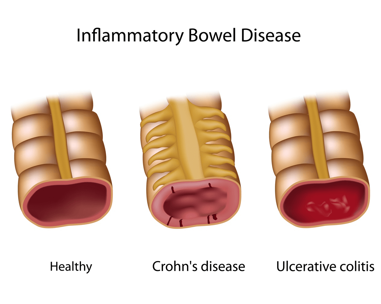 Inflammatory bowel diseases