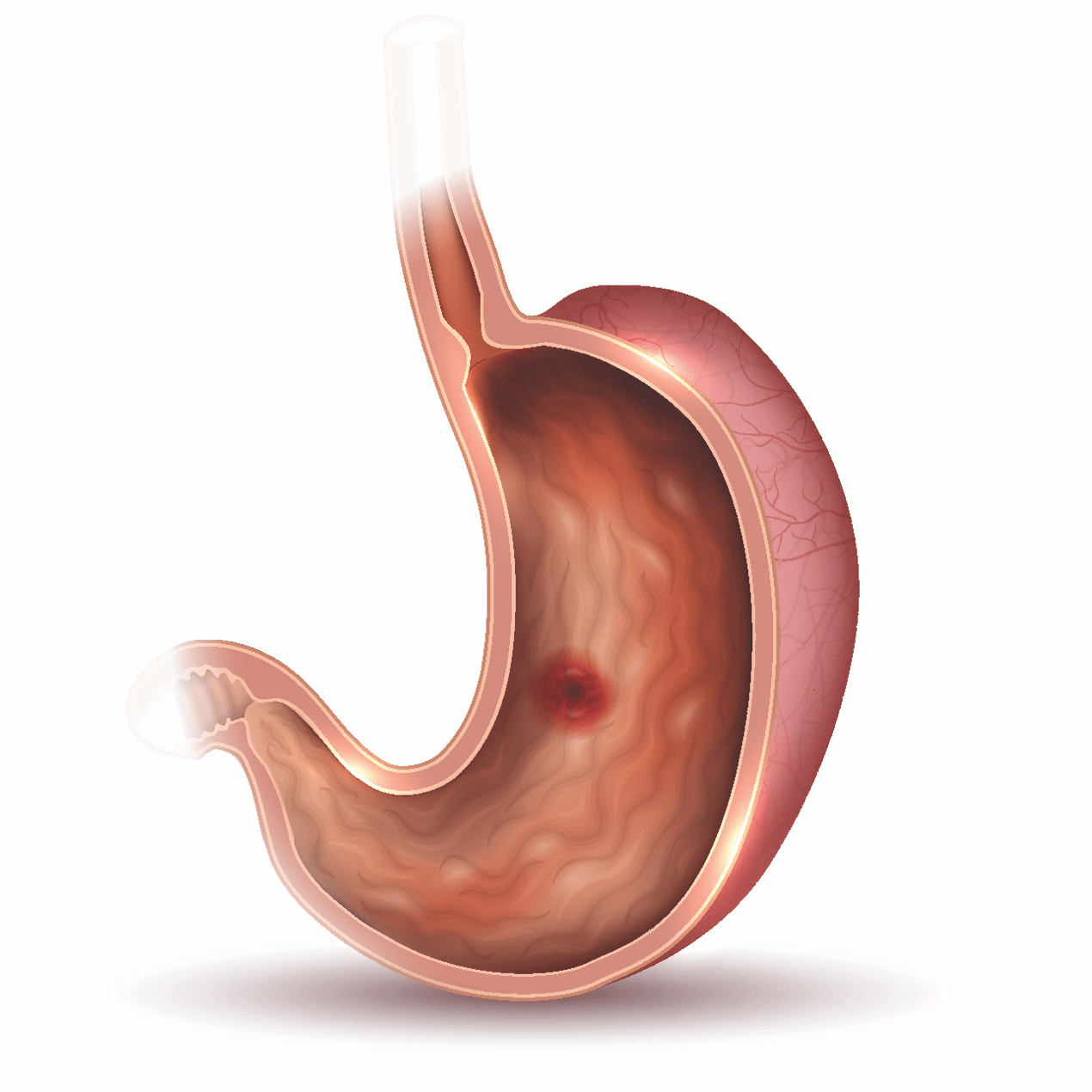Gastrointestinal bleeding