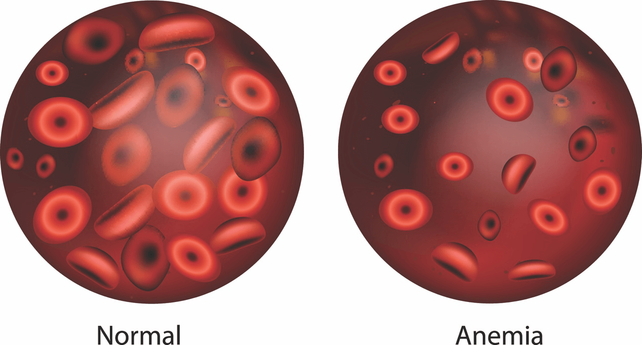 Anaemia