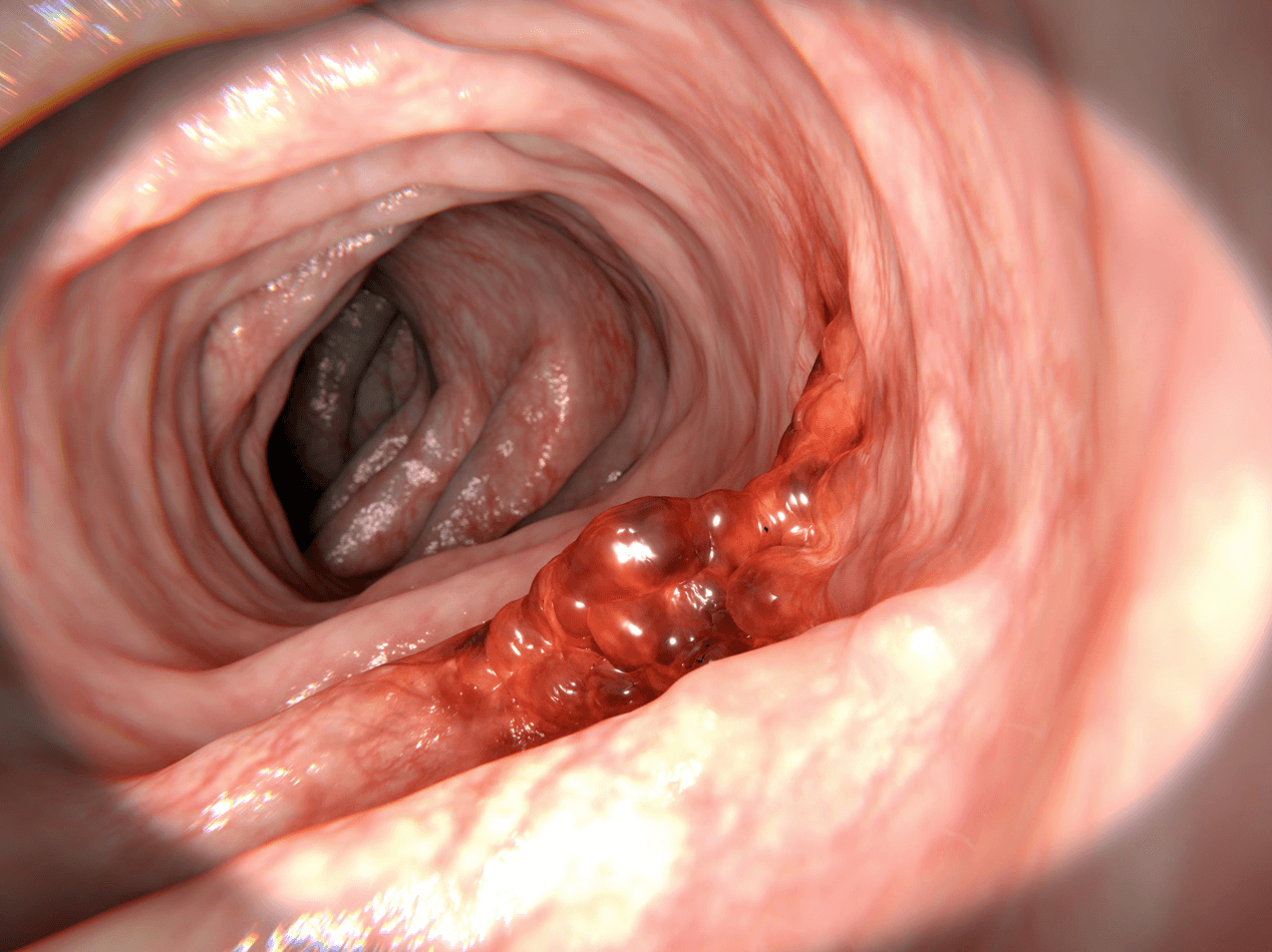 Bowel cancer