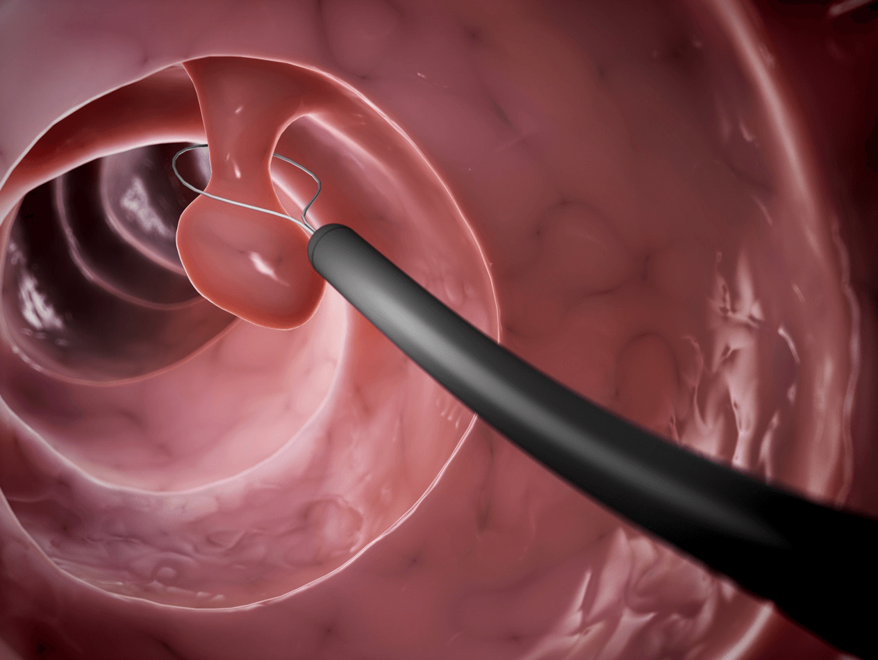 Colonoscopy
